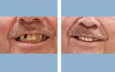 Before and After